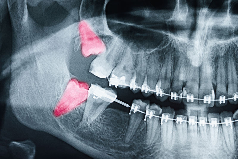 dental xray impacted wisdom teeth