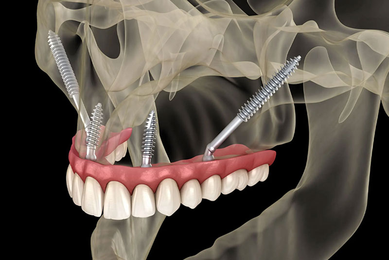 zygomatic implants