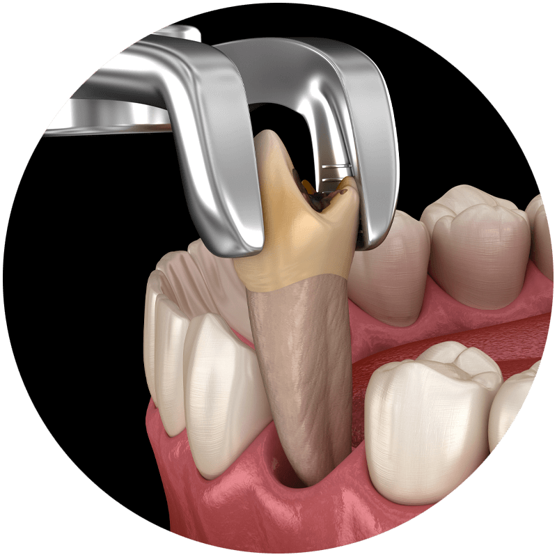 tooth extraction graphic front